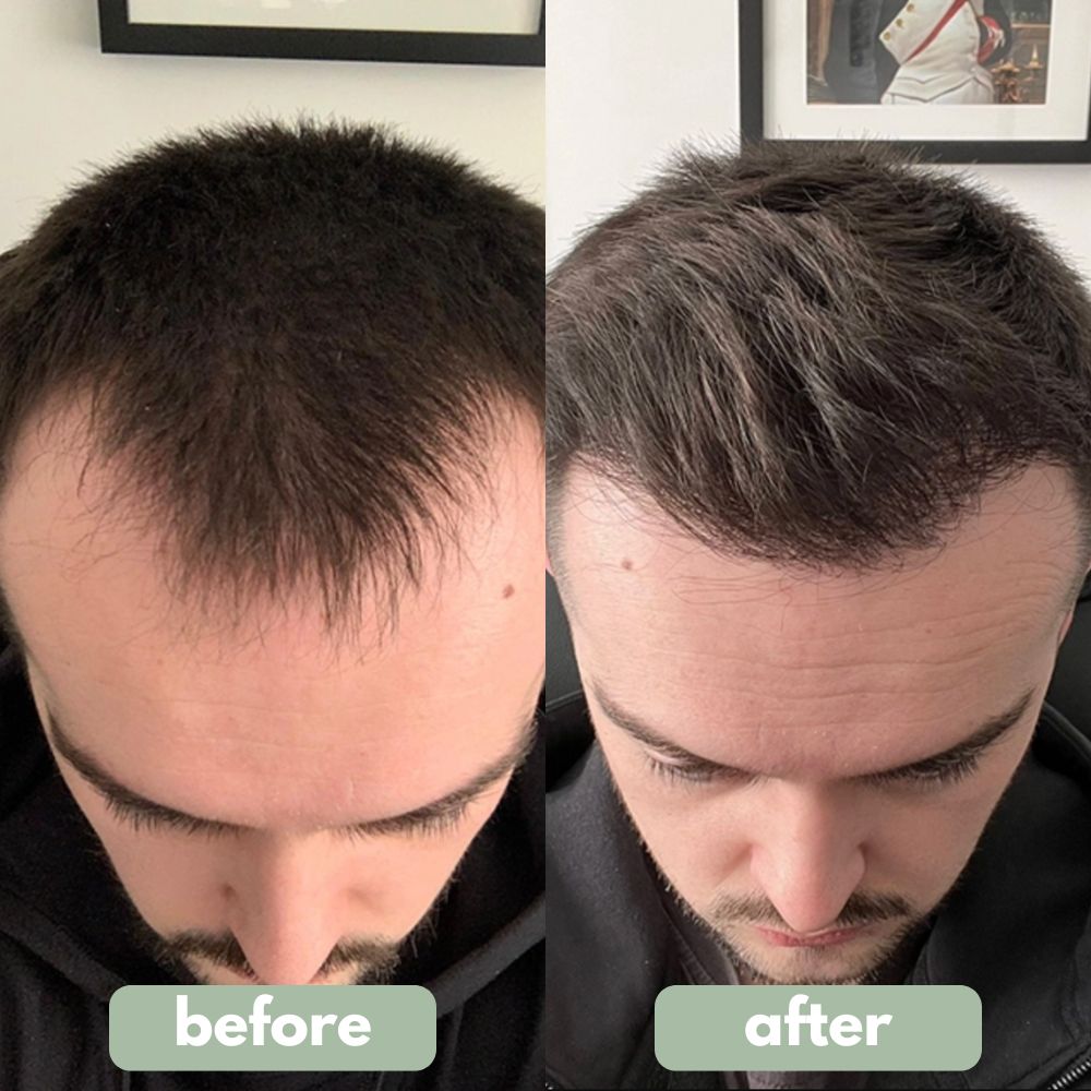 Reverse - Hair Growth Serum
